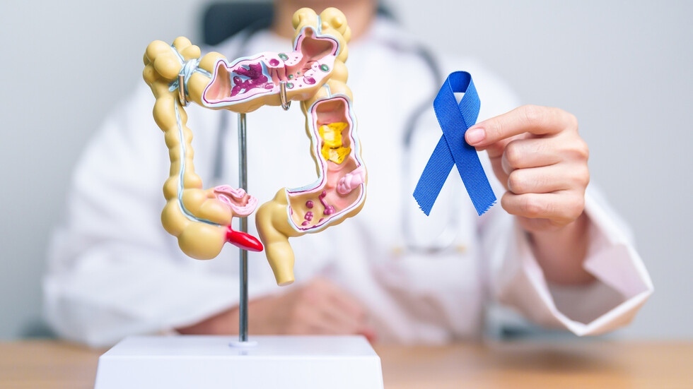 Ракът на дебелото черво взема 2000 жертви годишно у нас